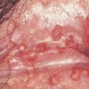 genital warts