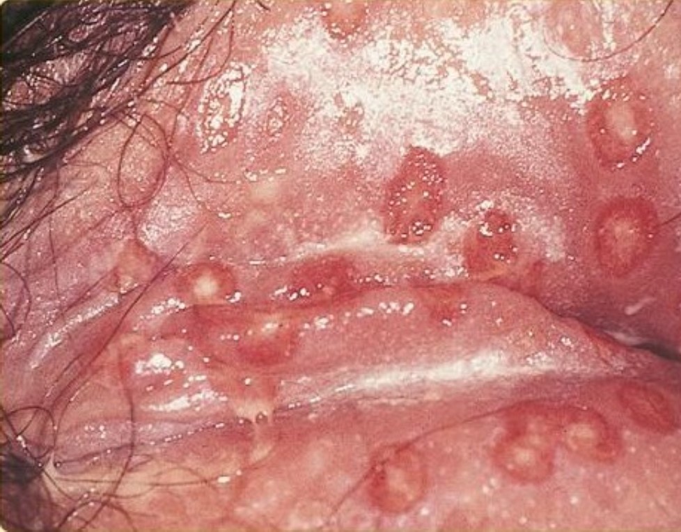Treatments for genital wart post thumbnail image