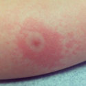 Lyme disease