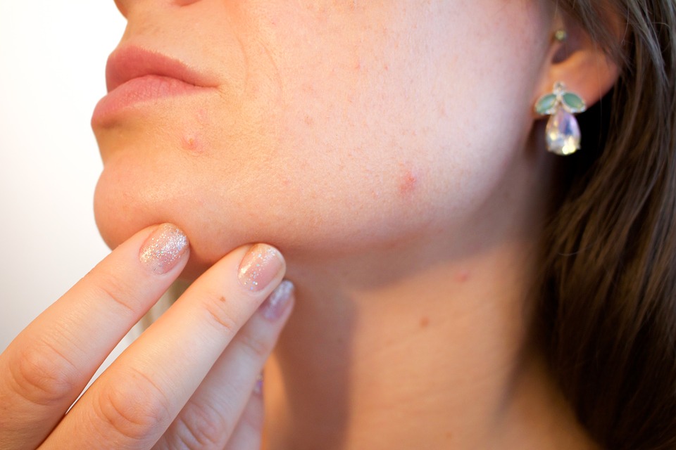 girl suffering from acne